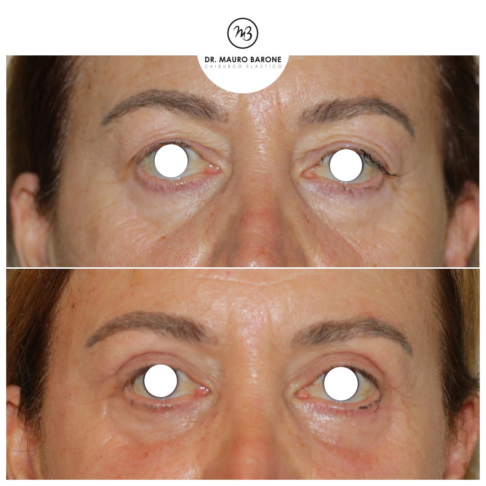 Lifting del terzo medio del volto, blefaroplastica superiore e lipofilling: l’obiettivo è il ringiovanimento dello sguardo
