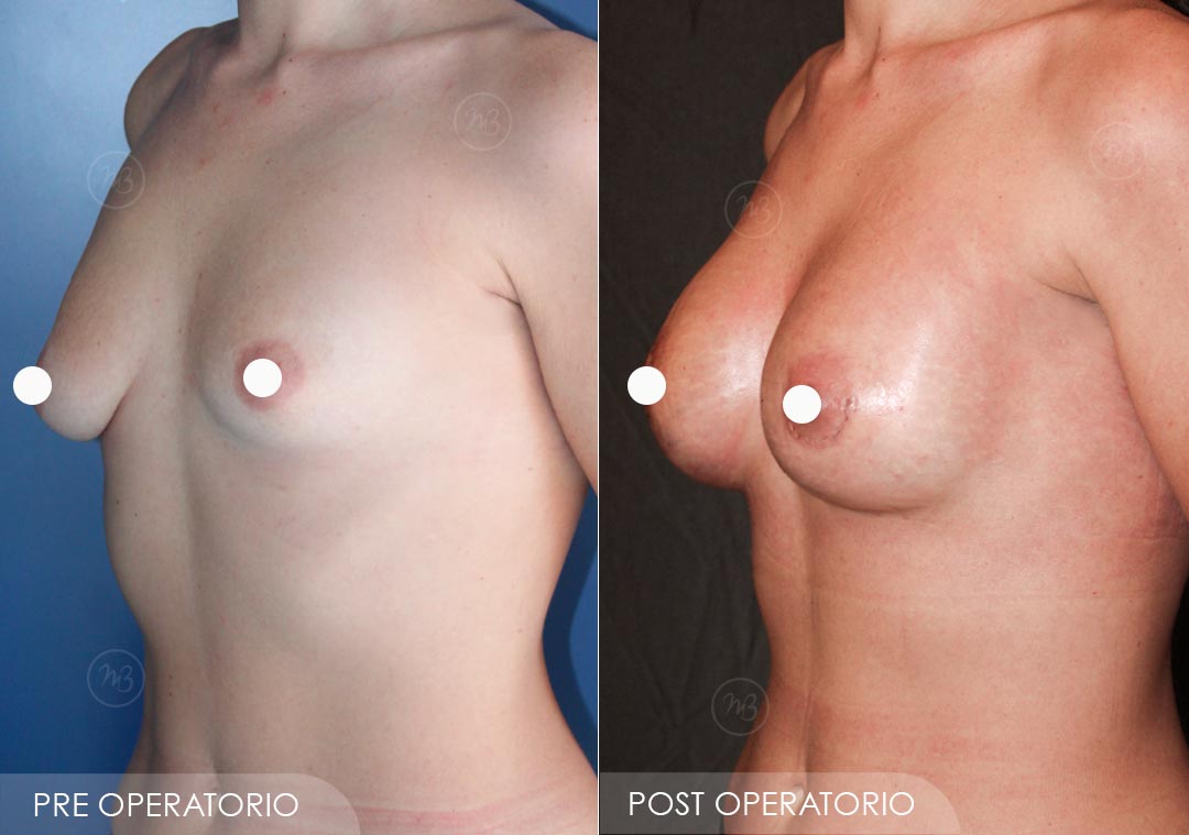 Correzione mammelle tuberose asimmetriche con protesi uguali