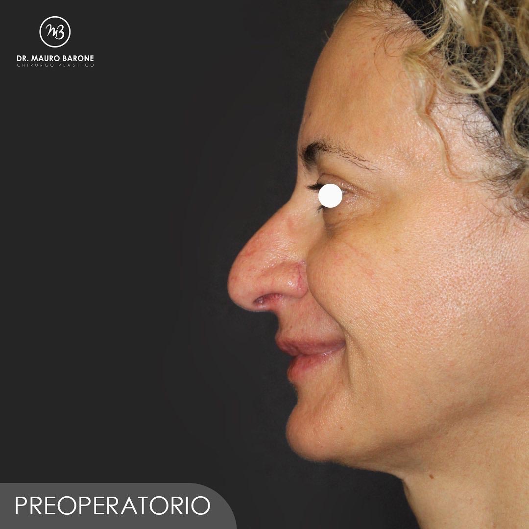 rinosettoplastica-preoperatorio