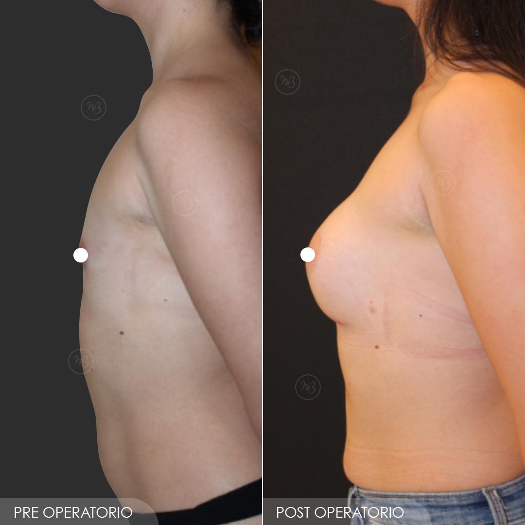 Dott Barone - Pectus Excavatum 2