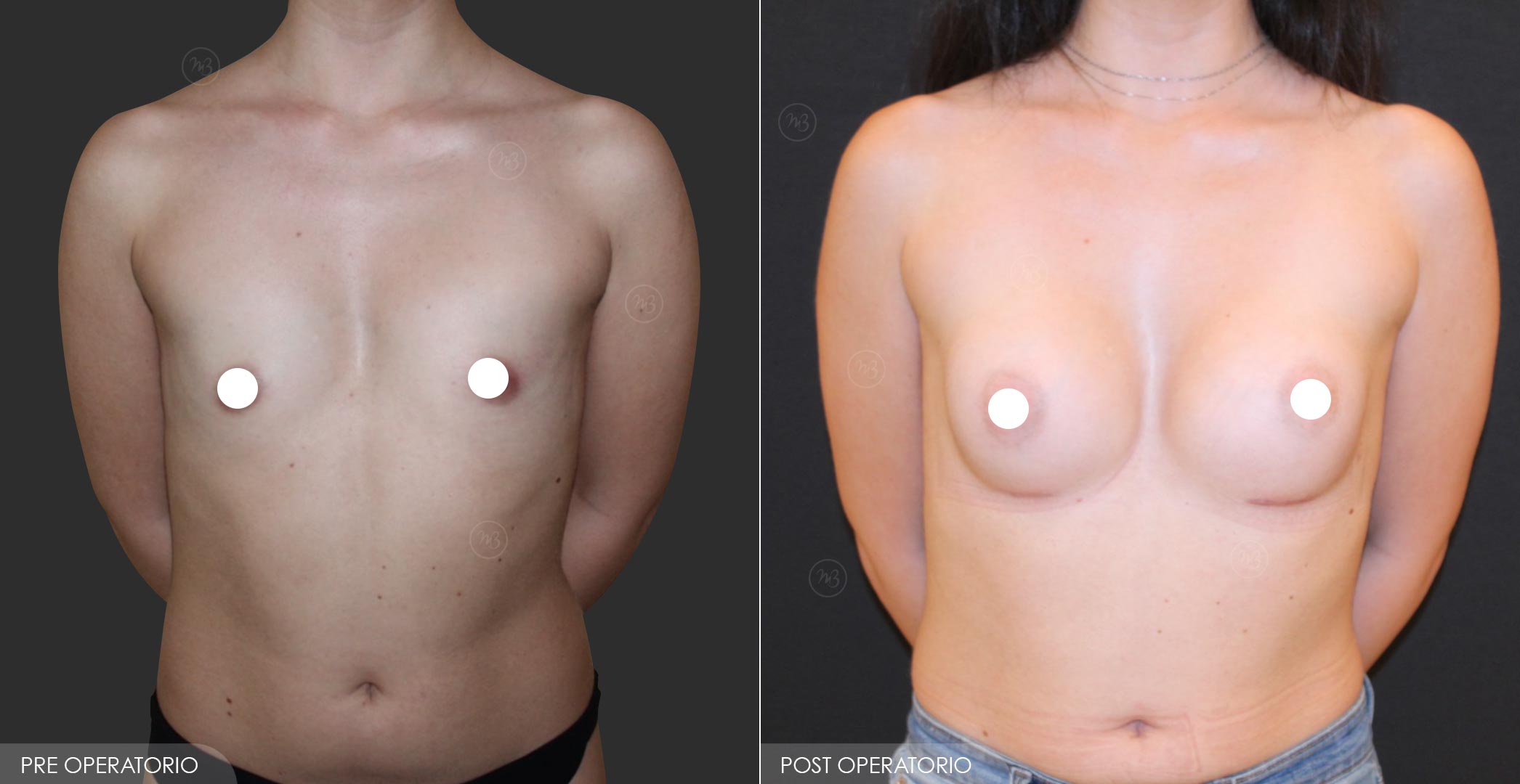 Dott Barone - Pectus Excavatum 3