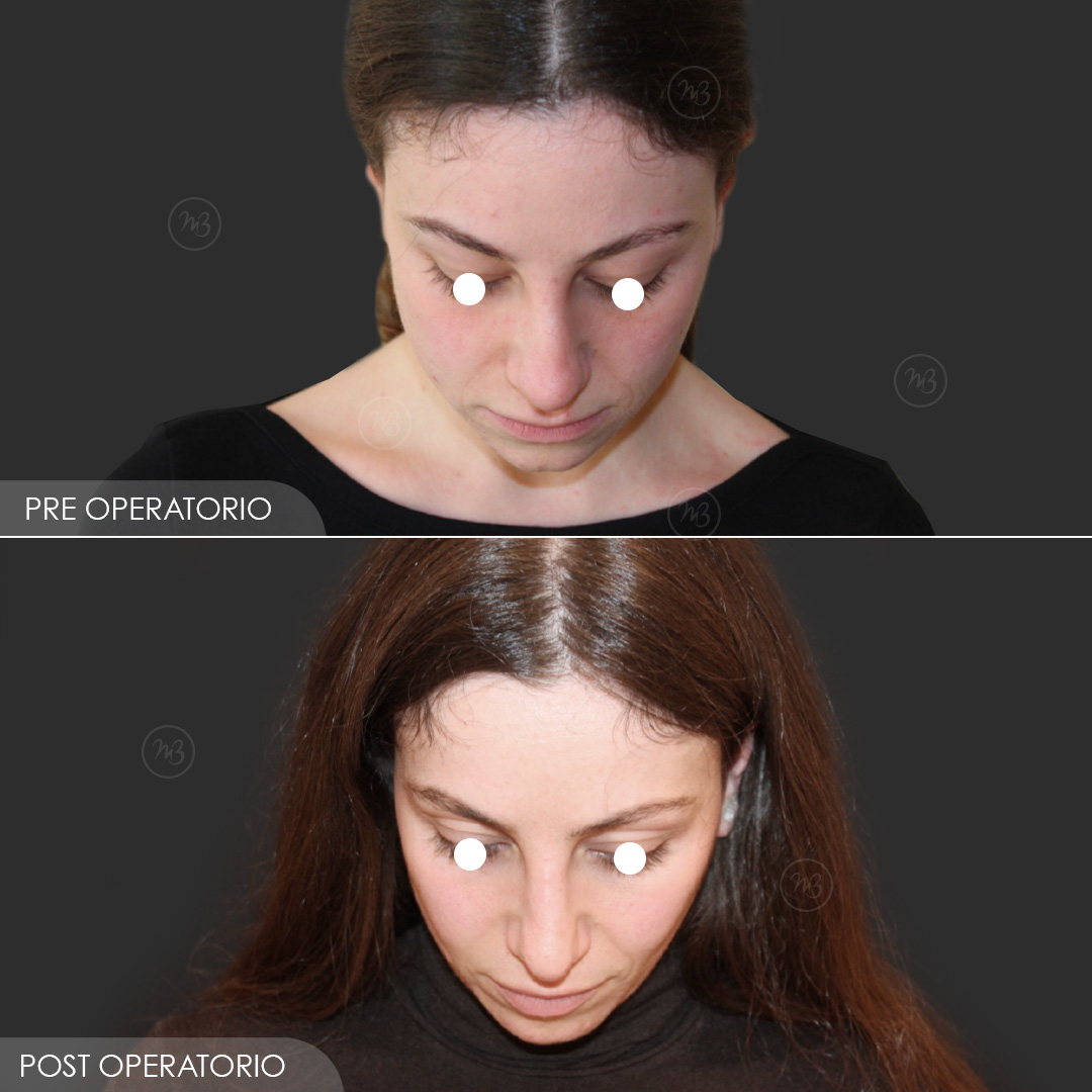 Dott Barone Rinosettoplastica 2